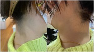 エリ脱毛　スタッフのテスト結果！！